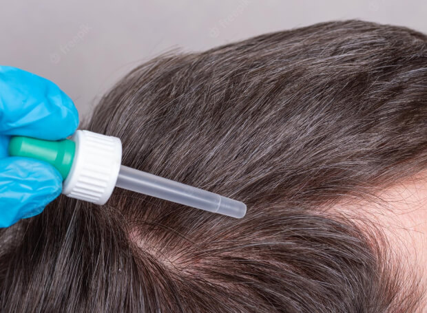General Causes of Hair loss