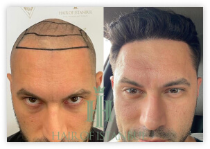 Hair Loss in Male